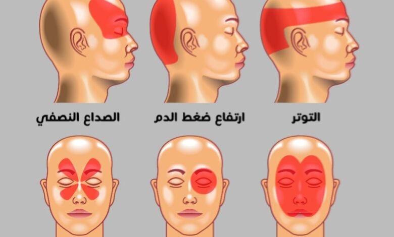 أنواع الصداع