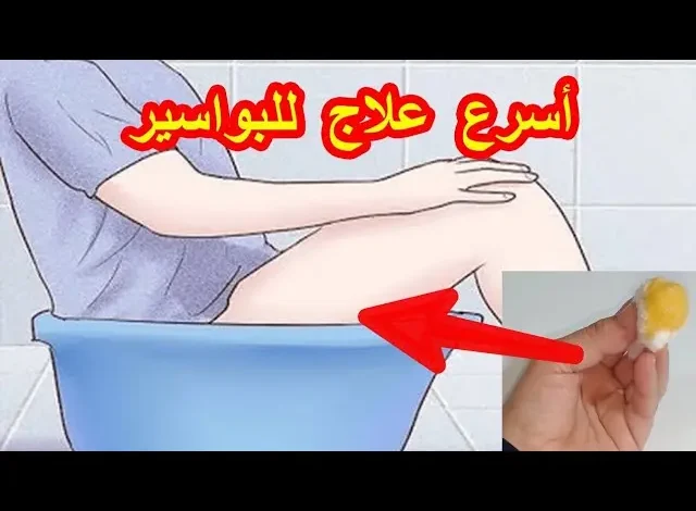 علاج يقضي على البواسير نهائياً